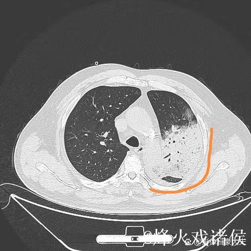 埃迪-豪：得肺炎住院后，意识到医疗体系与医护人员至关重要